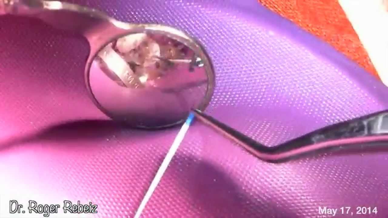 RCT Tips & Tricks , Dr. Roger Rebeiz YouTube