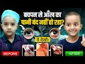 Watery Eyes in Child | DCR Eye Surgery Treatment