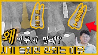 눕고 내려오고~발치 후 임플란트 미루지 말라는 이유 대.공.개