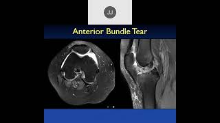 MRI of the Knee Ligaments | Part 4, 2023