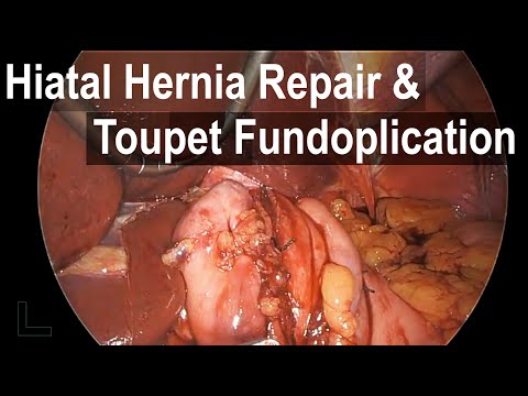 Toupet Fundoplication with Hiatal Hernia Repair - Animasjon og faktisk kirurgisk opptak