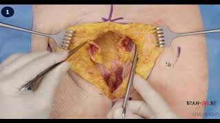 Maylard Incision آموزش انسزیون جراحی میلارد