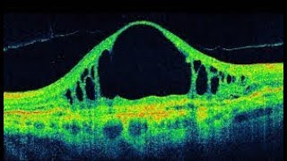 التصوير الضوئي المقطعي للشبكية (Optical coherence tomography (OCT