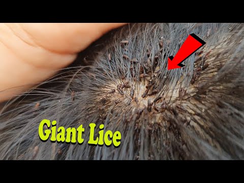 Big Lice Removal - We help remove thousand lice from short hair boy
