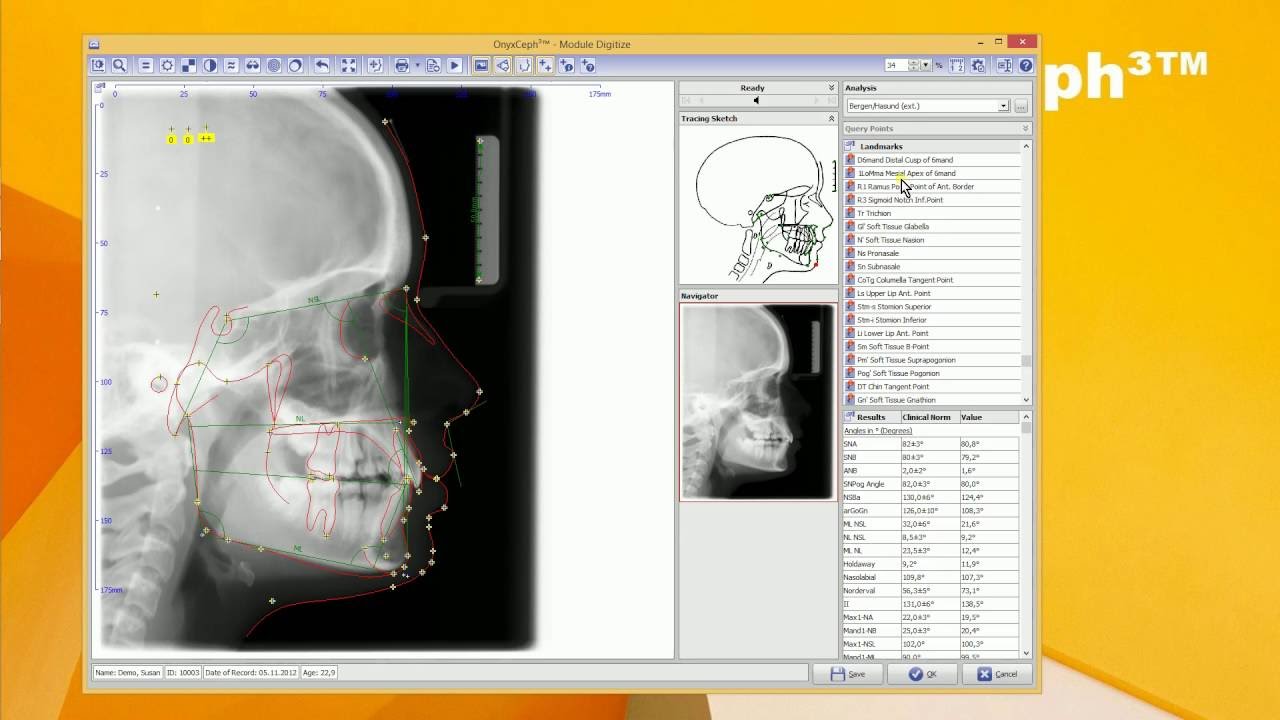 Oneceph OnyxCeph³™ Module Digitize 2D (Lateral Ceph) - YouTube