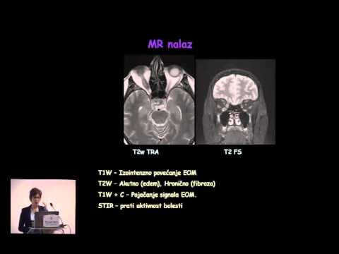 MRI i tiroidna orbitopatija  kliničko   radiološka korelacija   Natasa Prvulovic Bunovic