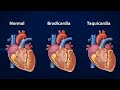 انواع دقات القلب الطبيعيه والغير طبيعيه