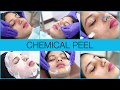 Chemical Peel for Acne: Before & After