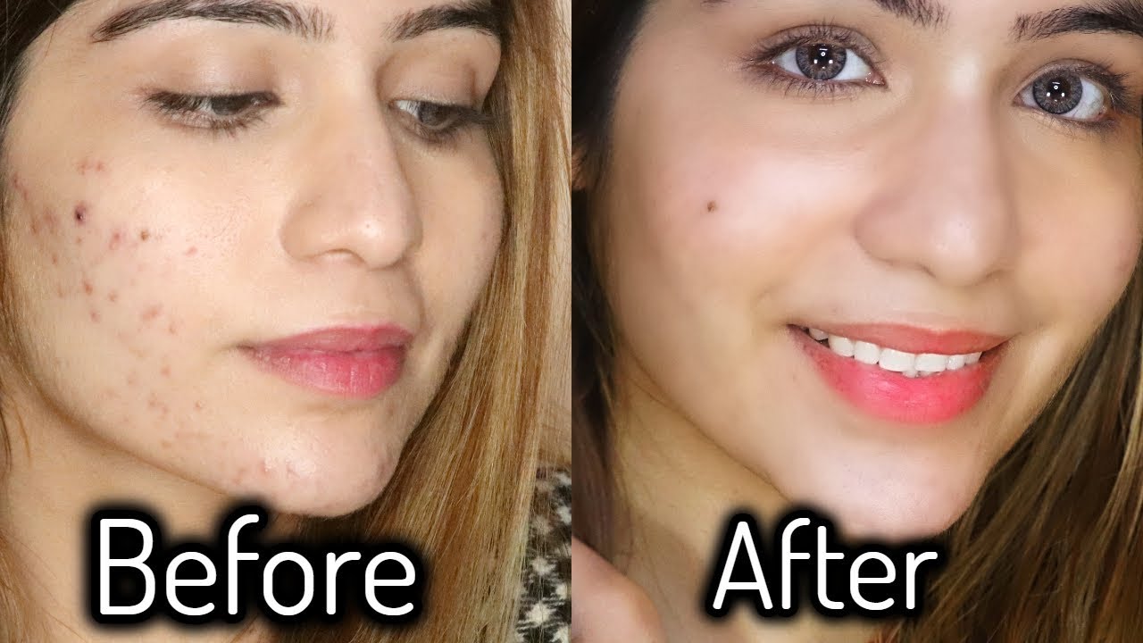 My Acne SKIN CARE Routine (4 Steps) + MY Acne Story YouTube