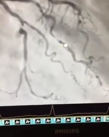 İLERİ YAŞ ANJİYO YAPILMASINA ENGEL MİDİR?