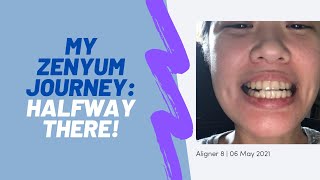 My Zenyum Journey: 70 days wearing aligners by The Klaudster 1,119 views 2 years ago 1 minute, 52 seconds