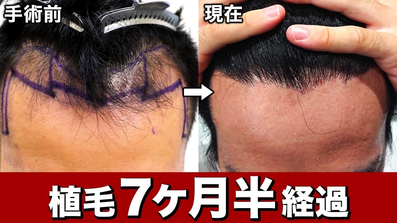 植毛7ヶ月半】M字ハゲの手術経過！密度が物足りない？【薄毛】 - YouTube