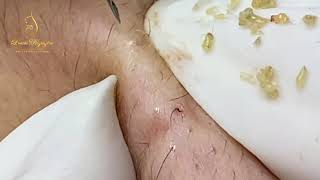 BLACKHEADS EXTRACTION (245) | Loan Nguyen