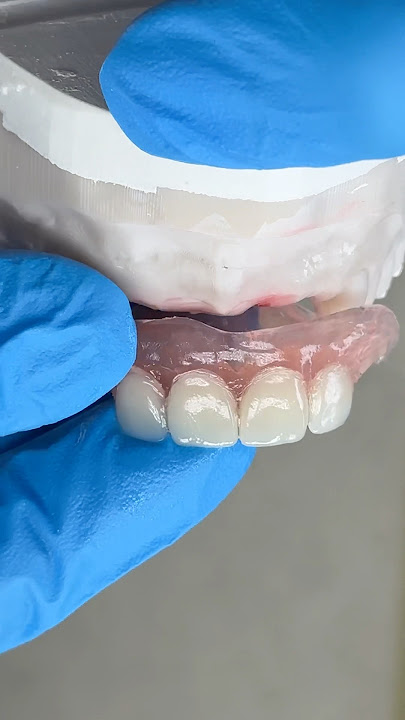 Anterior Nesbit Partial #lsk121shorts #dentist #teeth