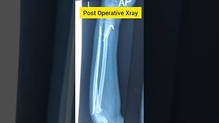 Fracture radius ulna bone to united remodeling process bone#Forearm Fracture#Remodeling process