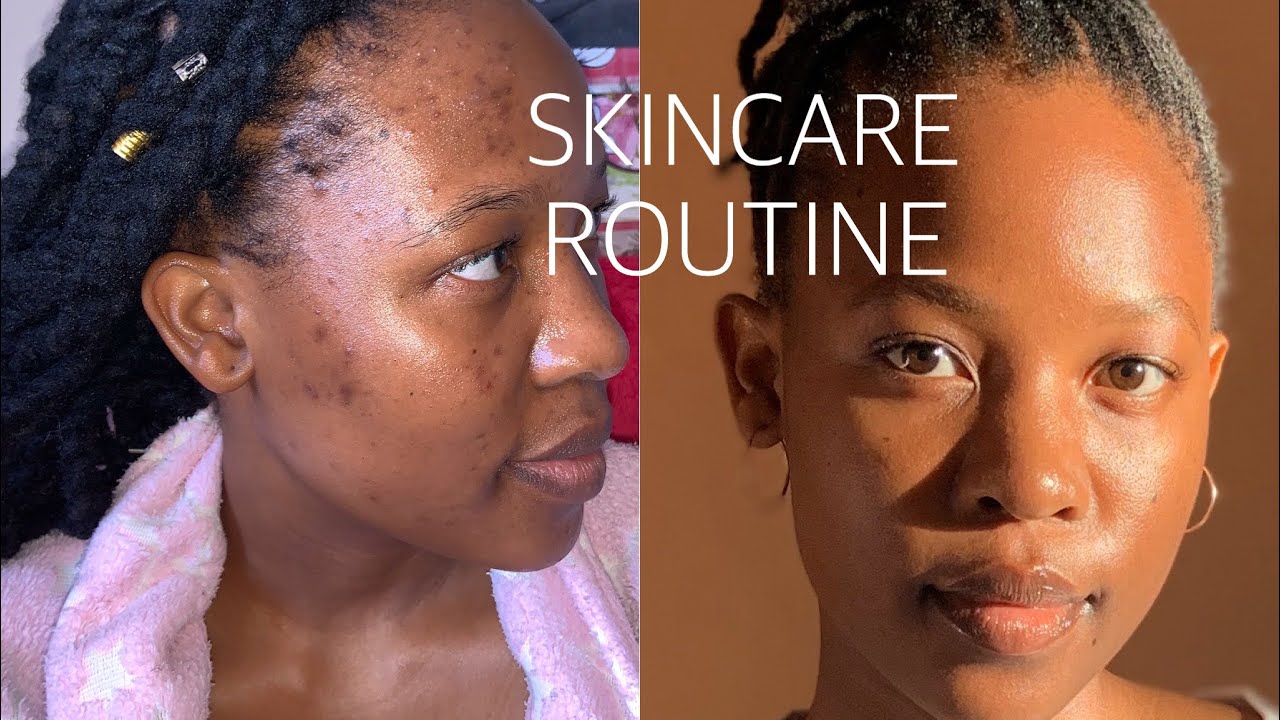 HOW I GOT RID OF MY ACNE WITHIN 2 MONTHS!! (maintaining clear skin ...