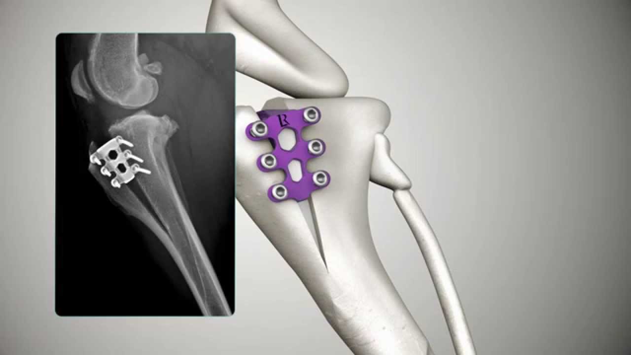 hjem Praktisk Morse kode Tibial Tuberosity Advancement: TTA RAPID - YouTube