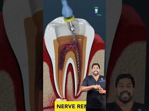 வேர் சிகிச்சை எப்படி செய்வார்கள்? How the Root Canal is Done? | Dr.Karthikeyan | Denta Kings
