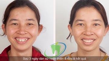 Dán sứ veneer đóng khe thưa, khắc phục hình thể răng bị dị dạng nhanh chóng