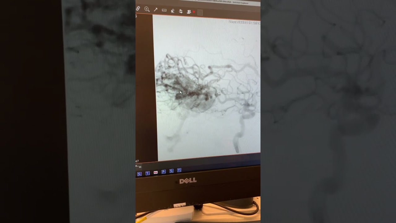 Angiogram Showing Blood Flow after Embolization