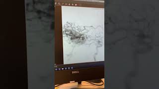 Angiogram Showing Blood Flow after Embolization