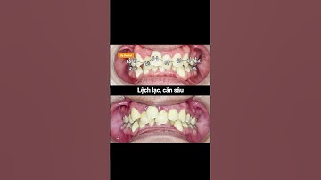 Cận cảnh quá trình niềng răng lệch lạc, cắn sâu