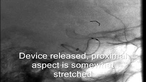 Pipeline Flex Case 1