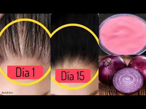 Video: Qué Hacer Si El Cabello De Tu Cabeza Se Cae Rápidamente