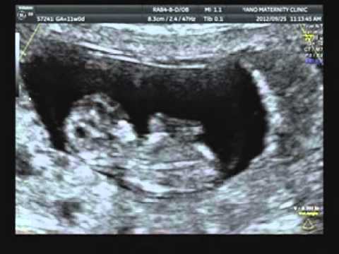 Lea Mahalo 妊娠１１週 エコー動画 初４d 彡 いちごくらいの大きさ Youtube