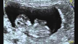 Lea Mahalo 妊娠１１週 エコー動画 初４d 彡 いちごくらいの大きさ Youtube