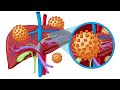 # tricks of hepatitis or liver infection or inflammation or swelling CINDERELLA NURSING CLASSES