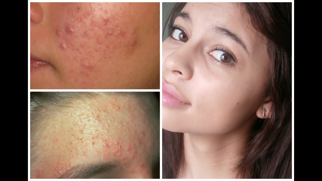 How I Cleared My Skin Products Tips For Fast Results You How I Cleared My Skin Products Tips For Fast Results