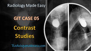 FRCR Radiology: 40 yrs old patient presented with dysphagia and regurgitation | GIT Contrast Case 05