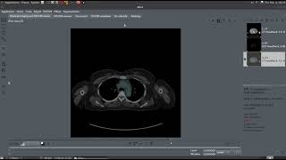 Aliza DICOM Viewer. CT-PET Fusion. PET SUV.