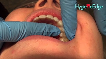 How to use a DIAGNOdent