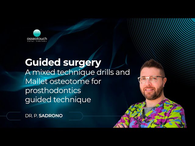A mixed technique drills and mallet osteotome for prosthodontics guided technique