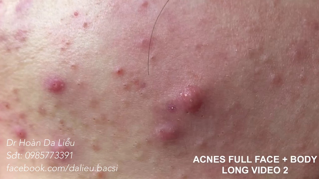 Dermatologist squeeze Pimples whitehead Blackhead Pustule anti Acnes dermatologist-squeeze-pimples-whitehead-blackhead-pustule-anti-acnes