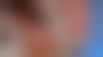 Canthotomy and Cantholysis: For Emergency Orbital Compartment Syndrome or Routine Eyelid Surgery