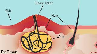 ماهو الناسور العصعصي_What is a pilonidal sinus?
