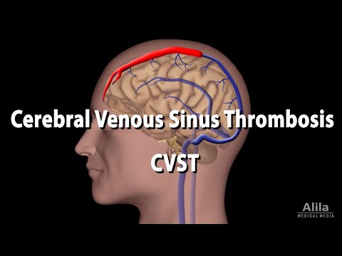 Cerebral Venous Sinus Thrombosis, CVST, Animation