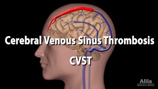 Cerebral Venous Sinus Thrombosis, CVST, Animation