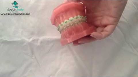 Digital Education- Elastics Module- https://www.straightsmilesolutions.com/