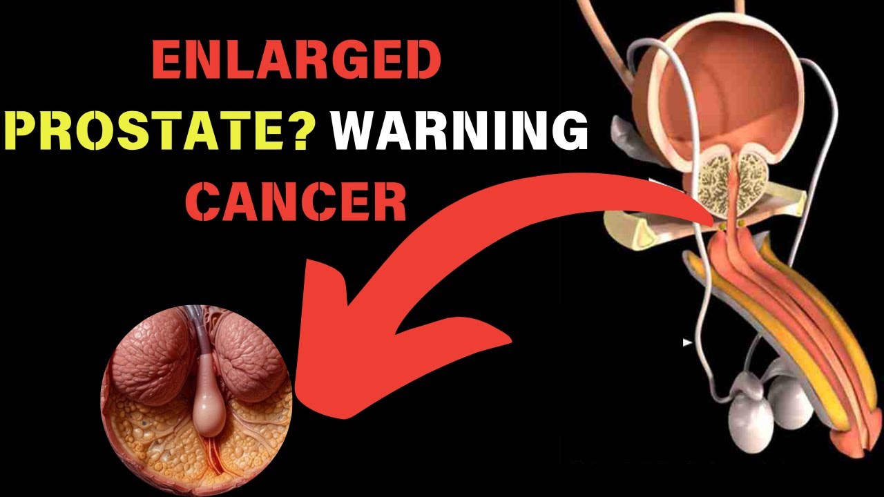 Prostate Warning Add ENLARGED PROSTATE? WARNING PROSTATE CANCER - YouTube