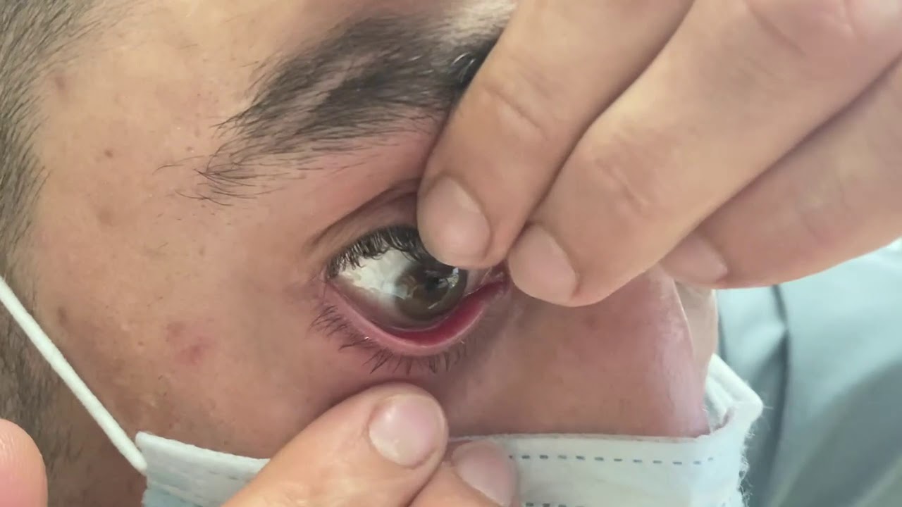 How to remove a gas permeable contact lens