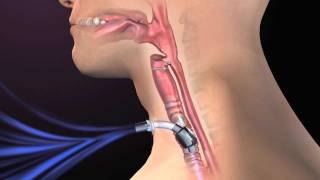 Clinical Complications of Tracheostomy