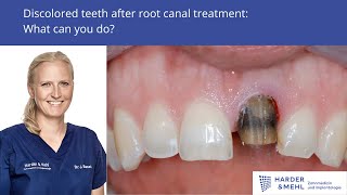 Discolored teeth after root canal treatment  what can you do?