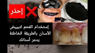إحذر تبييض الأسنان بالفحم بالطريقة الخاطئة يدمر أسنانك. إليك الطريقة الصحيحة لتبييض الأسنان بالفحم screenshot 1
