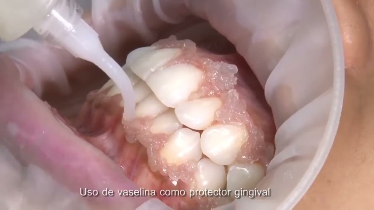 Técnicas de Blanqueamiento en Consultorio BM4(PowerBleaching Office 37%)