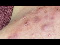 Extractions And Acne | Điều Trị Mụn - ThuyTruong#70