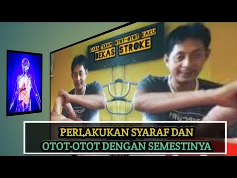 CARA MENGOBATI OTOT-OTOT BEKU DARI PENYAKIT STROKE